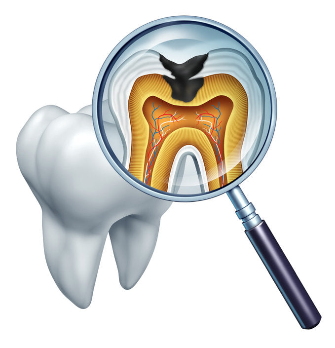 How to Prevent Tooth Decay
