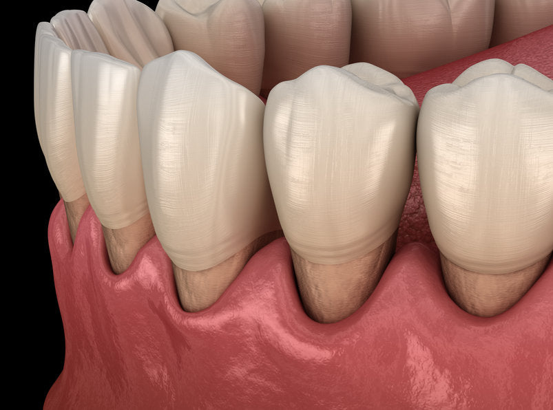 Image of gum recession of the teeth.