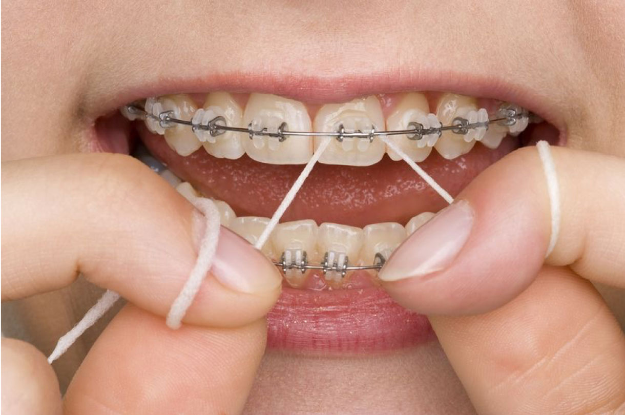 Water Flossing and Orthodontics