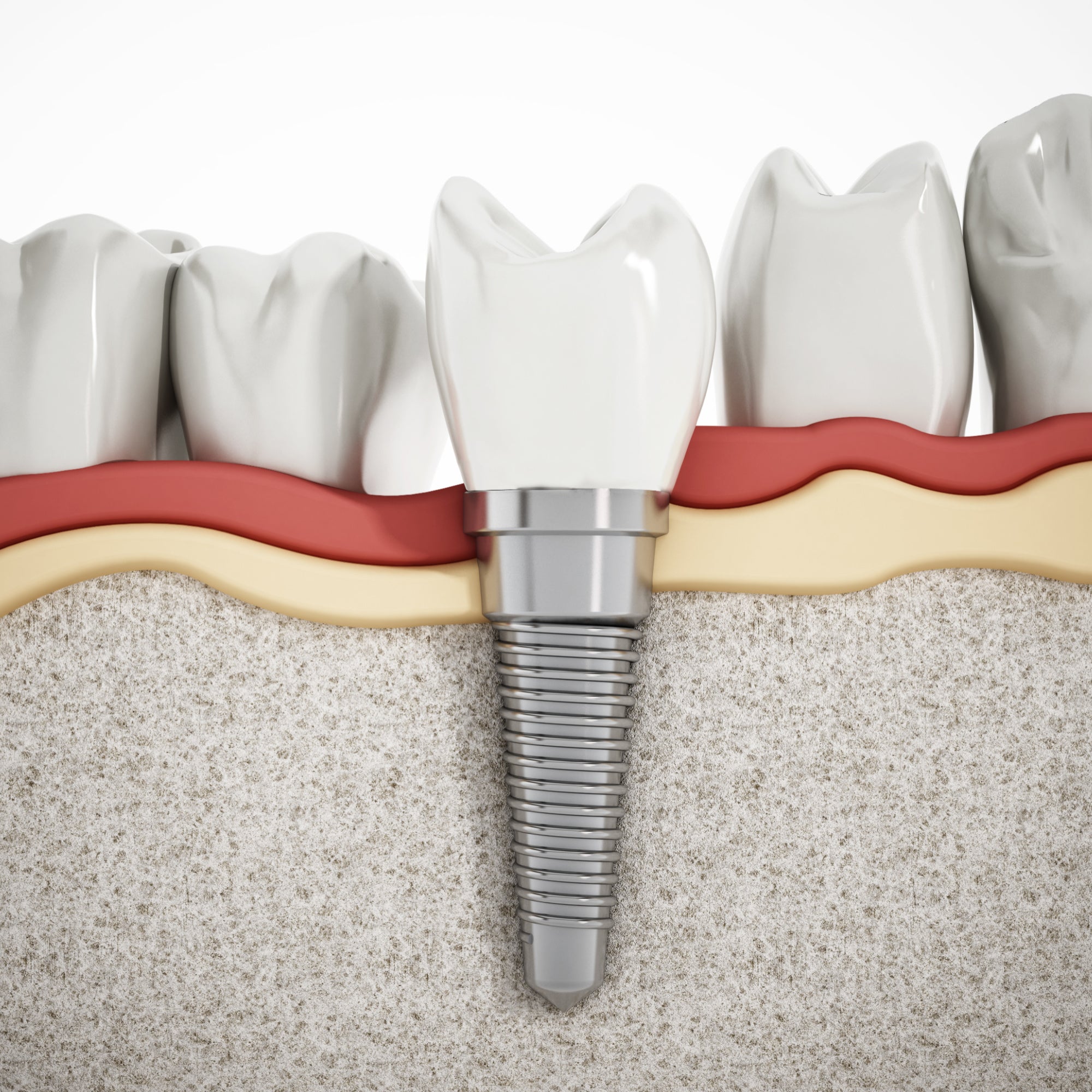 dental implant post, denture, tooth replacement abutement ceramic crown endosteal titanium zirconia