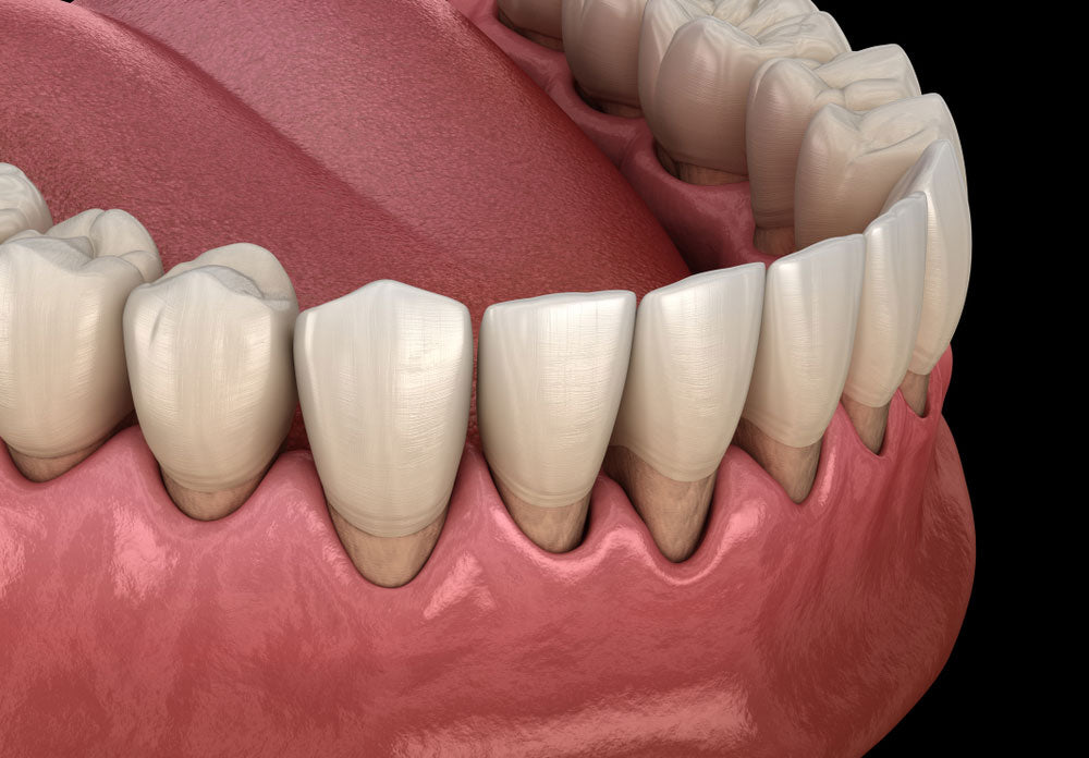 Bone loss from gingivitis, periodontitis