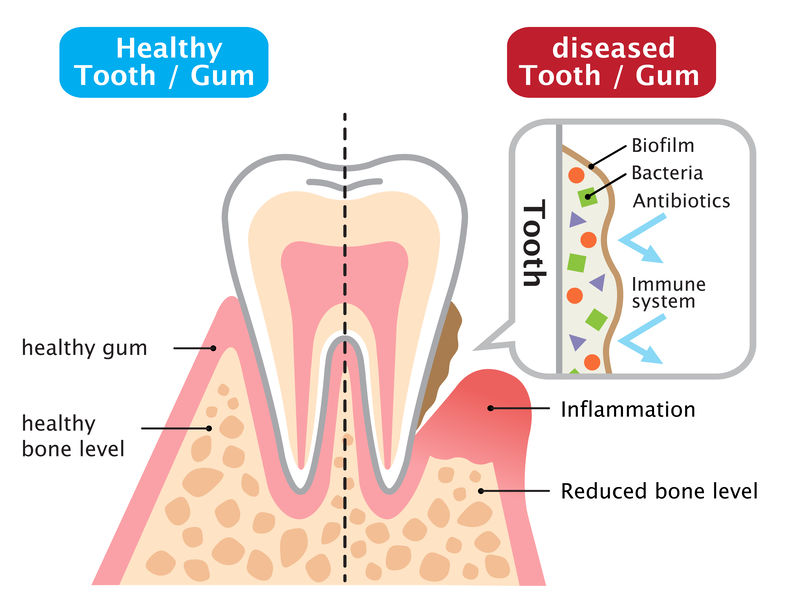 diseased tooth and gum and healthy tooth and gum