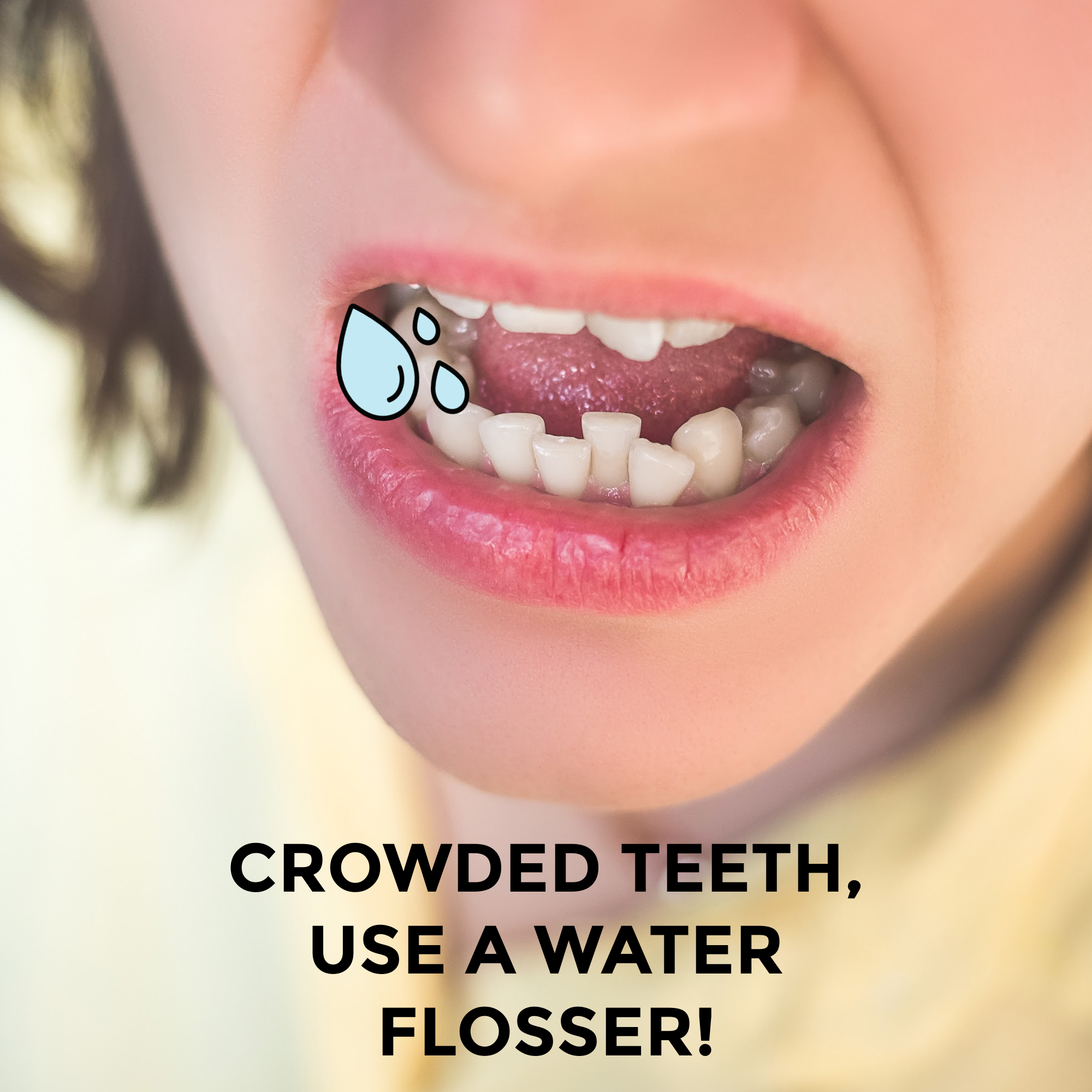 Shower flosser for crowded teeth as a flossing alternative