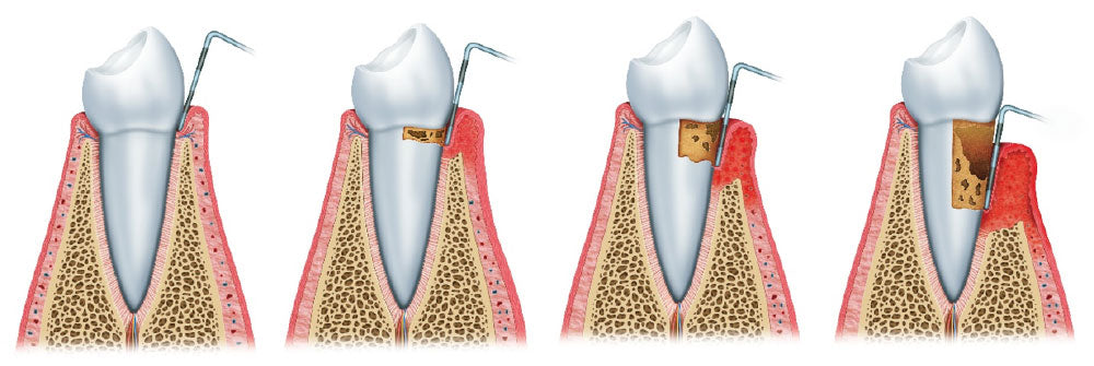 dental probe measuring pockets, healthy and diseased gums