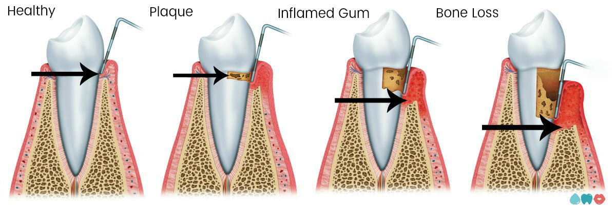 dental hygienist probes gum pockets assessing healthy or diseased gums